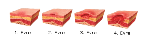 bası yarası evresi